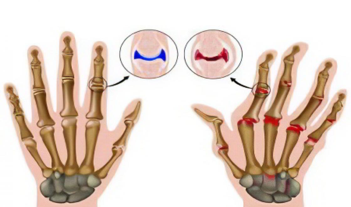 Leczenie artrozy palców - jak i co robić?